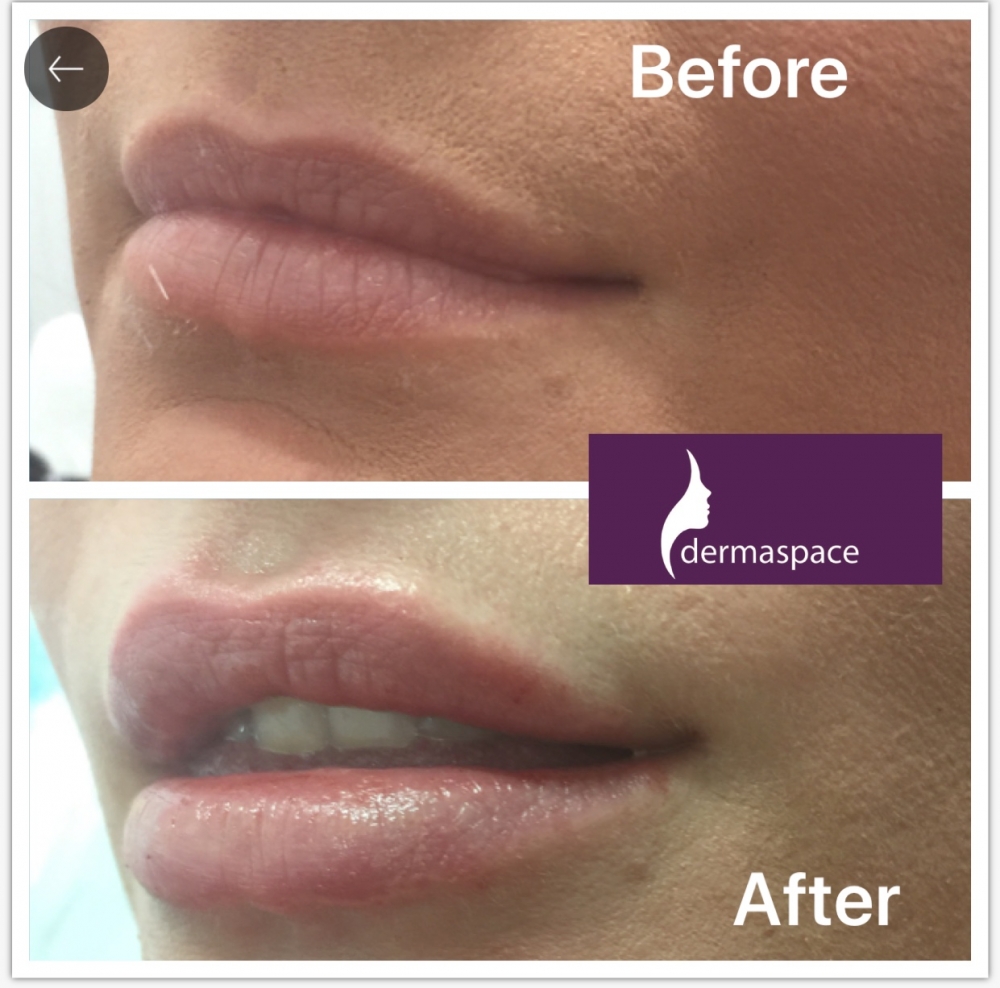 Dermaspace Huddersfield Blog Doctor Led Cosmetic Treatments 1ml Lip Filler